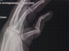 В Одессе пенсионерка напала на мужчину и сломала ему палец