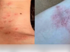 В Одессе неизвестный облил двух девочек кислотой