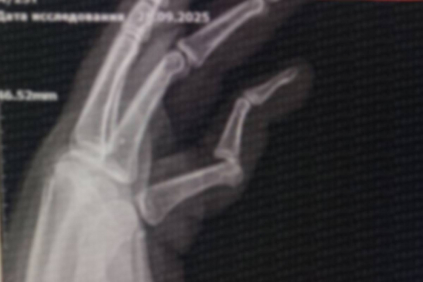 В Одессе пенсионерка напала на мужчину и сломала ему палец