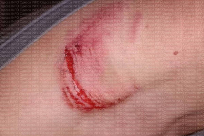 В Одесской области военный избил и покусал 14-летнего подростка